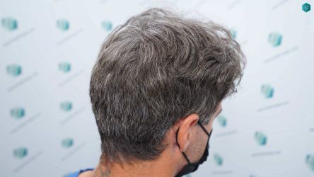 Injerto Capilar Técnica FUE Grafts 2519 (5393 Pelos) 4 3A ANTES DEL TRASPLANTE CAPILAR