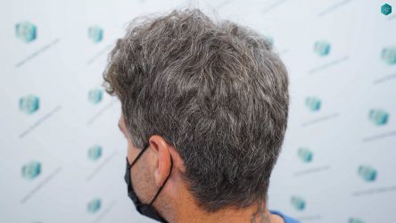 Injerto Capilar Técnica FUE Grafts 2519 (5393 Pelos) 5 3B ANTES DEL TRASPLANTE CAPILAR
