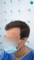 Injerto Capilar Técnica FUE Grafts 3060 (6835 Pelos) 3 4 ANTES DEL TRASPLANTE CAPILAR 1