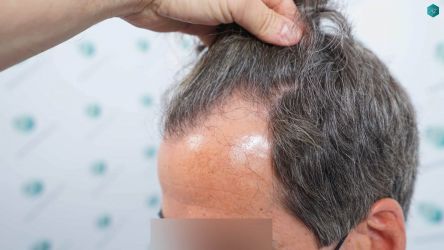 Injerto Capilar Técnica FUE Grafts 2519 (5393 Pelos) 6 4 ANTES DEL TRASPLANTE CAPILAR