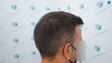 40 RESULTADOS A LOS 12 MESES 1