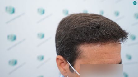 Injerto Capilar Técnica FUE Grafts 3060 (6835 Pelos) 38 40 RESULTADOS A LOS 12 MESES