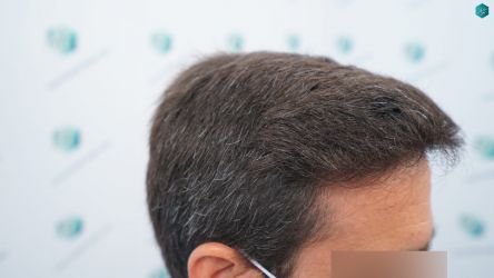 Injerto Capilar Técnica FUE Grafts 3060 (6835 Pelos) 39 40A RESULTADOS A LOS 12 MESES