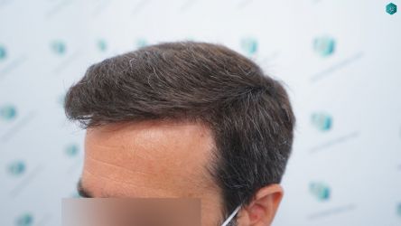 Injerto Capilar Técnica FUE Grafts 3060 (6835 Pelos) 40 41 RESULTADOS A LOS 12 MESES