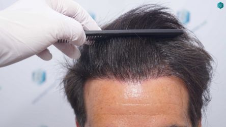 Injerto Capilar Técnica FUE Grafts 2519 (5393 Pelos) 40 42 RESULTADOS 12 MESES
