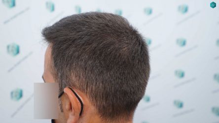 42 RESULTADOS A LOS 12 MESES 1