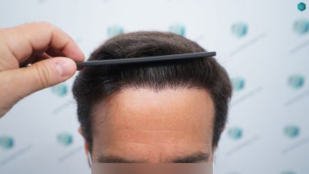 Injerto Capilar Técnica FUE Grafts 3060 (6835 Pelos) 41 42 RESULTADOS A LOS 12 MESES