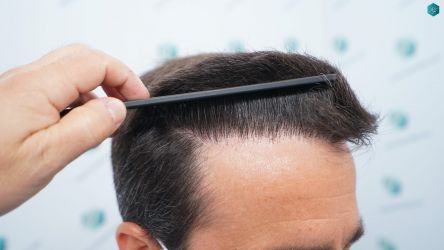 Injerto Capilar Técnica FUE Grafts 3060 (6835 Pelos) 42 44 RESULTADOS A LOS 12 MESES