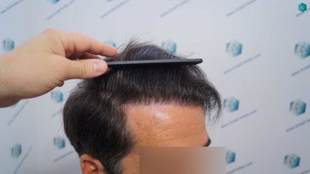 Injerto Capilar Técnica FUE Grafts 2519 (5393 Pelos) 41 45 RESULTADOS 12 MESES
