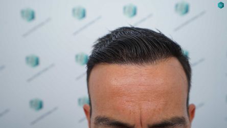 45A RESULTADOS A LOS 12 MESES