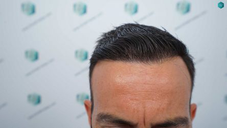 45C RESULTADOS A LOS 12 MESES