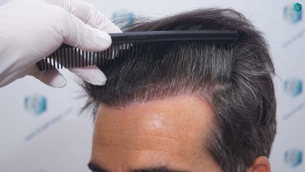 Injerto Capilar Técnica FUE Grafts 2519 (5393 Pelos) 42 46 RESULTADOS 12 MESES