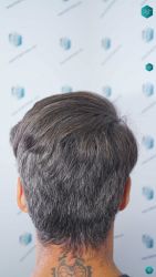Injerto Capilar Técnica FUE Grafts 2519 (5393 Pelos) 43 47 RESULTADOS 12 MESES