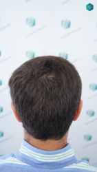 Injerto Capilar Técnica FUE Grafts 3060 (6835 Pelos) 44 47 RESULTADOS A LOS 12 MESES