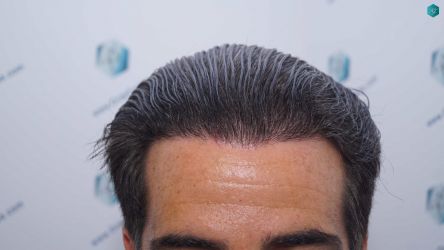 Injerto Capilar Técnica FUE Grafts 2519 (5393 Pelos) 45 49 RESULTADOS 12 MESES