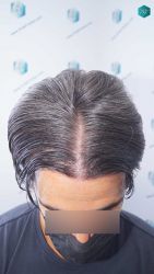 Injerto Capilar Técnica FUE Grafts 2519 (5393 Pelos) 46 49A RESULTADOS 12 MESES