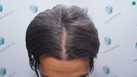 Injerto Capilar Técnica FUE Grafts 2519 (5393 Pelos) 47 49B RESULTADOS 12 MESES