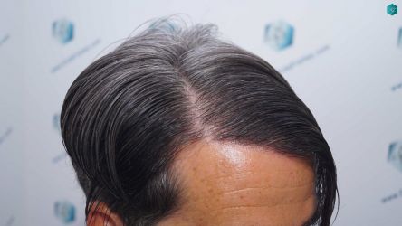 Injerto Capilar Técnica FUE Grafts 2519 (5393 Pelos) 48 49C RESULTADOS 12 MESES