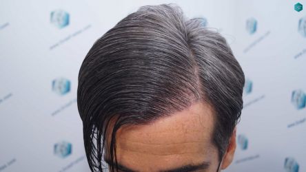 Injerto Capilar Técnica FUE Grafts 2519 (5393 Pelos) 49 49D RESULTADOS 12 MESES