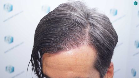 Injerto Capilar Técnica FUE Grafts 2519 (5393 Pelos) 50 49E RESULTADOS 12 MESES