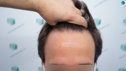 Injerto Capilar Técnica FUE Grafts 3060 (6835 Pelos) 4 5 ANTES DEL TRASPLANTE CAPILAR 1