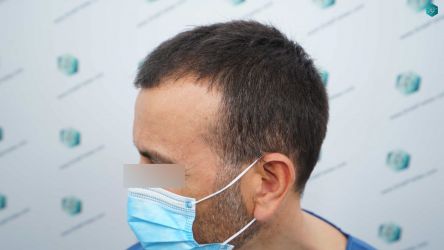 5 ANTES DEL TRASPLANTE CAPILAR 2
