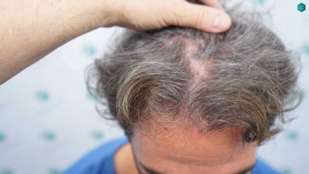 Injerto Capilar Técnica FUE Grafts 2519 (5393 Pelos) 7 5 ANTES DEL TRASPLANTE CAPILAR