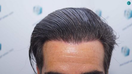 Injerto Capilar Técnica FUE Grafts 2519 (5393 Pelos) 51 50B RESULTADOS 12 MESES