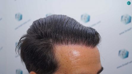 Injerto Capilar Técnica FUE Grafts 2519 (5393 Pelos) 52 51 RESULTADOS 12 MESES