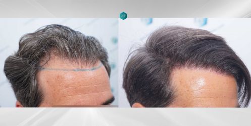 Injerto Capilar Técnica FUE Grafts 2519 (5393 Pelos) 53 53 COMPARATIVAS