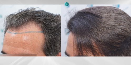Injerto Capilar Técnica FUE Grafts 2519 (5393 Pelos) 54 54 COMPARATIVAS