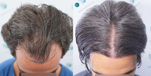 Injerto Capilar Técnica FUE Grafts 2519 (5393 Pelos) 55 55 COMPARATIVAS