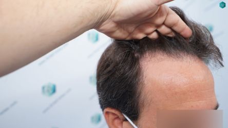 Injerto Capilar Técnica FUE Grafts 3060 (6835 Pelos) 5 6 ANTES DEL TRASPLANTE CAPILAR 1