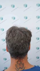 Injerto Capilar Técnica FUE Grafts 2519 (5393 Pelos) 8 6 ANTES DEL TRASPLANTE CAPILAR