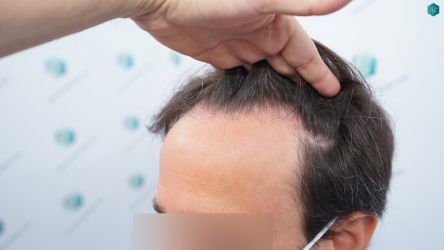 Injerto Capilar Técnica FUE Grafts 3060 (6835 Pelos) 6 7 ANTES DEL TRASPLANTE CAPILAR 1