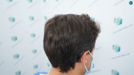 Injerto Capilar Técnica FUE Grafts 3060 (6835 Pelos) 7 8 ANTES DEL TRASPLANTE CAPILAR