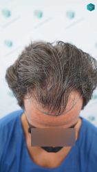 Injerto Capilar Técnica FUE Grafts 2519 (5393 Pelos) 10 9 DISENO LINEA DE INJERTO