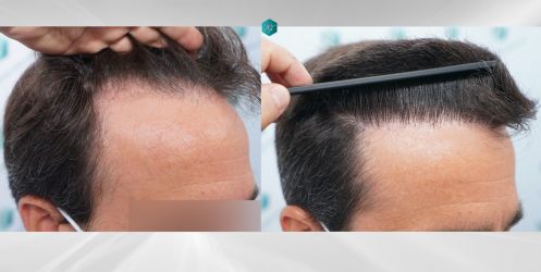 Injerto Capilar Técnica FUE Grafts 3060 (6835 Pelos) 46 fondo blanco copia 3