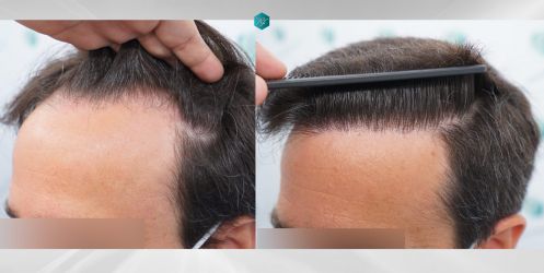 Injerto Capilar Técnica FUE Grafts 3060 (6835 Pelos) 47 fondo blanco copia 4