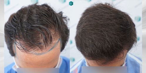 Injerto Capilar Técnica FUE Grafts 3060 (6835 Pelos) 48 fondo blanco copia
