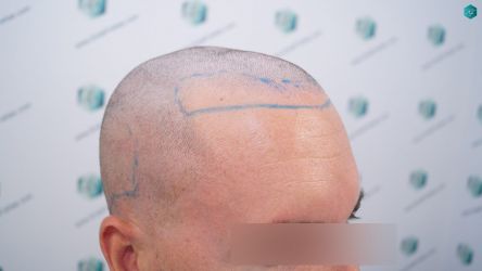 Injerto Capilar Técnica FUE Grafts 1852 (4121 Pelos) 9 Injerto Capilar Técnica FUE Grafts 1852 (4121 Pelos)