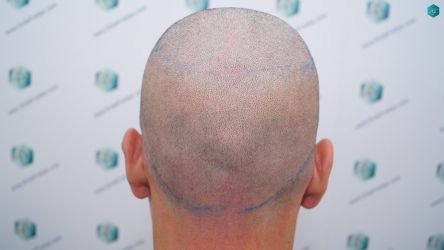 Injerto Capilar Técnica FUE Grafts 1852 (4121 Pelos) 11 Injerto Capilar Técnica FUE Grafts 1852 (4121 Pelos)