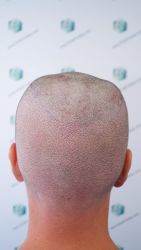 Injerto Capilar Técnica FUE Grafts 1852 (4121 Pelos) 14 Injerto Capilar Técnica FUE Grafts 1852 (4121 Pelos)