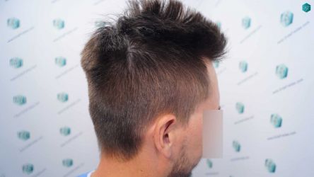 Injerto Capilar Técnica FUE Grafts 1852 (4121 Pelos) 1 Injerto Capilar Técnica FUE Grafts 1852 (4121 Pelos)