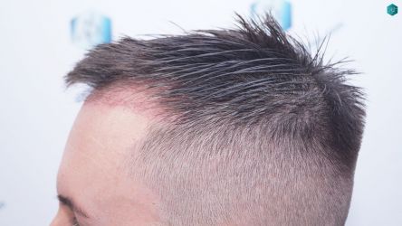 Injerto Capilar Técnica FUE Grafts 1852 (4121 Pelos) 18 Injerto Capilar Técnica FUE Grafts 1852 (4121 Pelos)