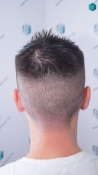 Injerto Capilar Técnica FUE Grafts 1852 (4121 Pelos) 19 Injerto Capilar Técnica FUE Grafts 1852 (4121 Pelos)