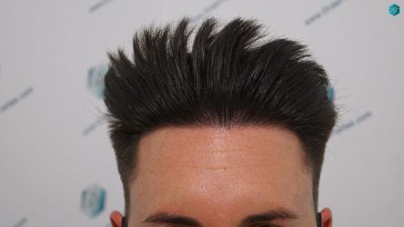 Injerto Capilar Técnica FUE Grafts 1852 (4121 Pelos) 20 Injerto Capilar Técnica FUE Grafts 1852 (4121 Pelos)