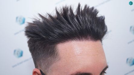 Injerto Capilar Técnica FUE Grafts 1852 (4121 Pelos) 21 Injerto Capilar Técnica FUE Grafts 1852 (4121 Pelos)