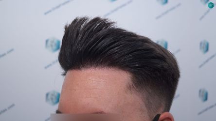 Injerto Capilar Técnica FUE Grafts 1852 (4121 Pelos) 22 Injerto Capilar Técnica FUE Grafts 1852 (4121 Pelos)