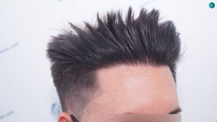 Injerto Capilar Técnica FUE Grafts 1852 (4121 Pelos) 23 Injerto Capilar Técnica FUE Grafts 1852 (4121 Pelos)